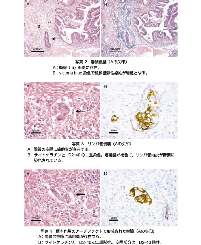 大腸 癌 肺 転移 余命